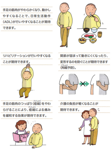 ボツリヌス療法の効果